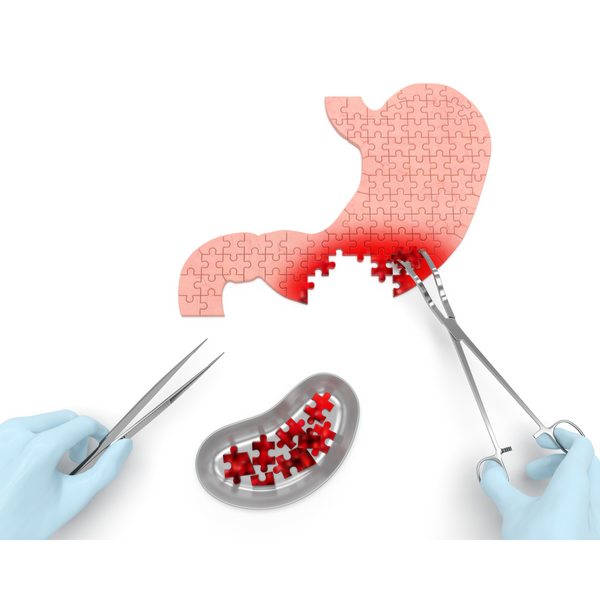 stomach gastric cancer natureal